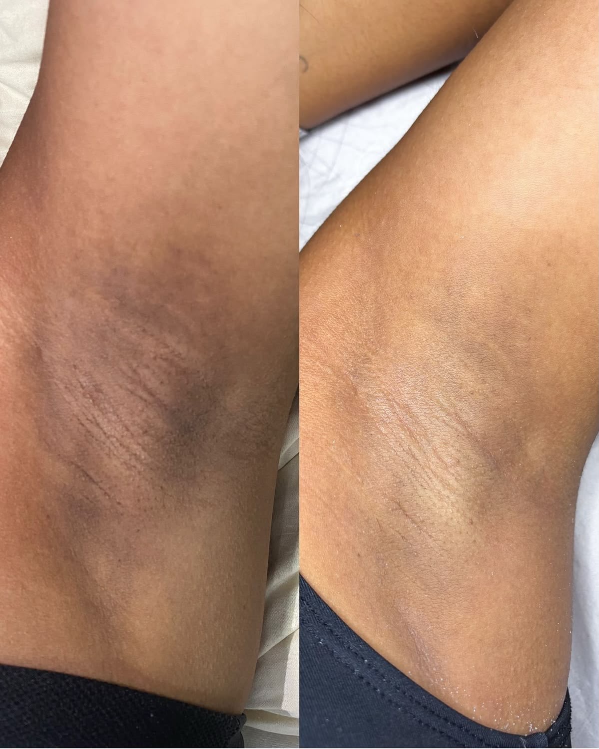 Antes e depois de clareamento íntimo a laser na região das axilas