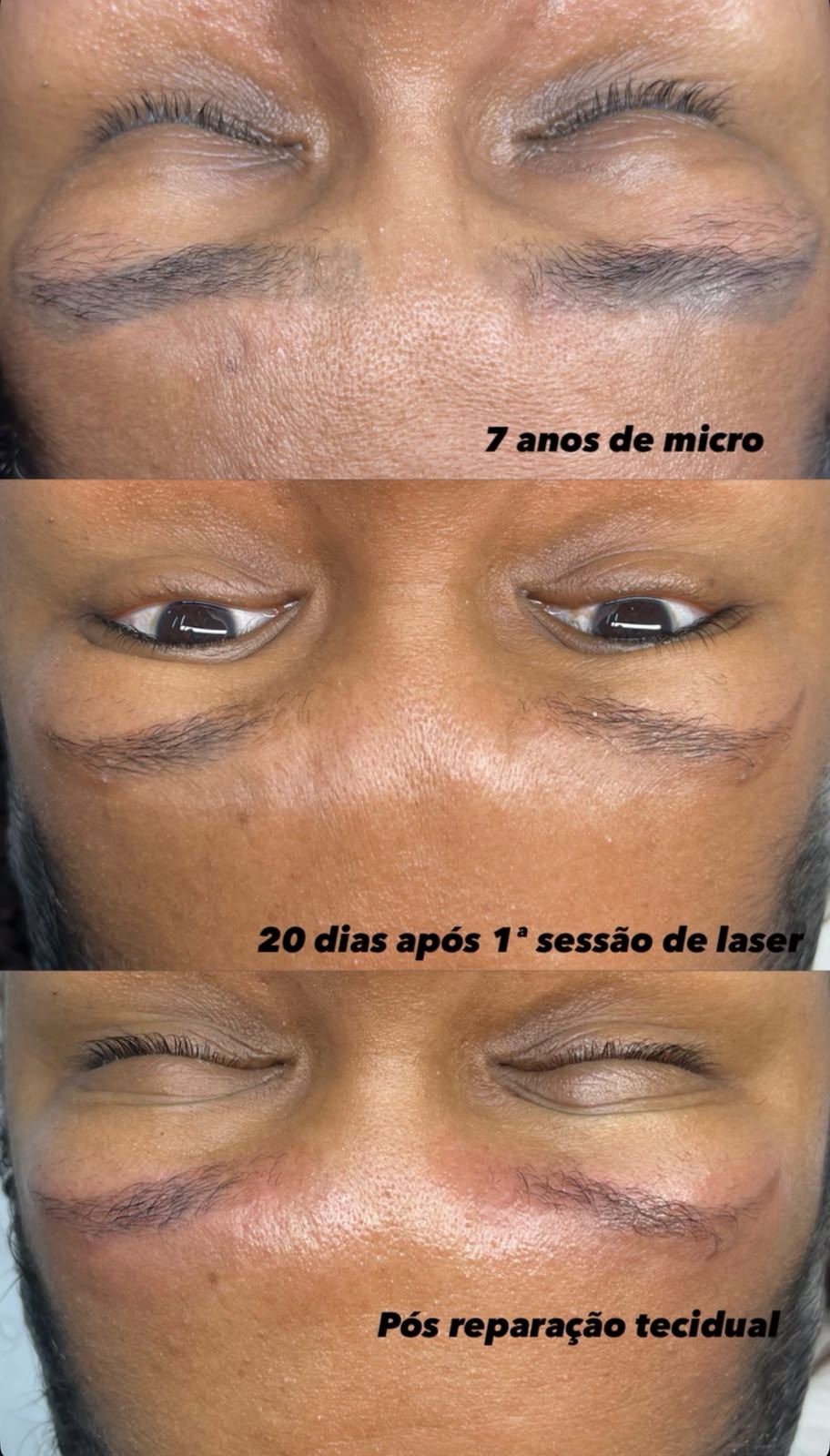Progressão de remoção a laser de micropigmentação de sobrancelhas em três etapas