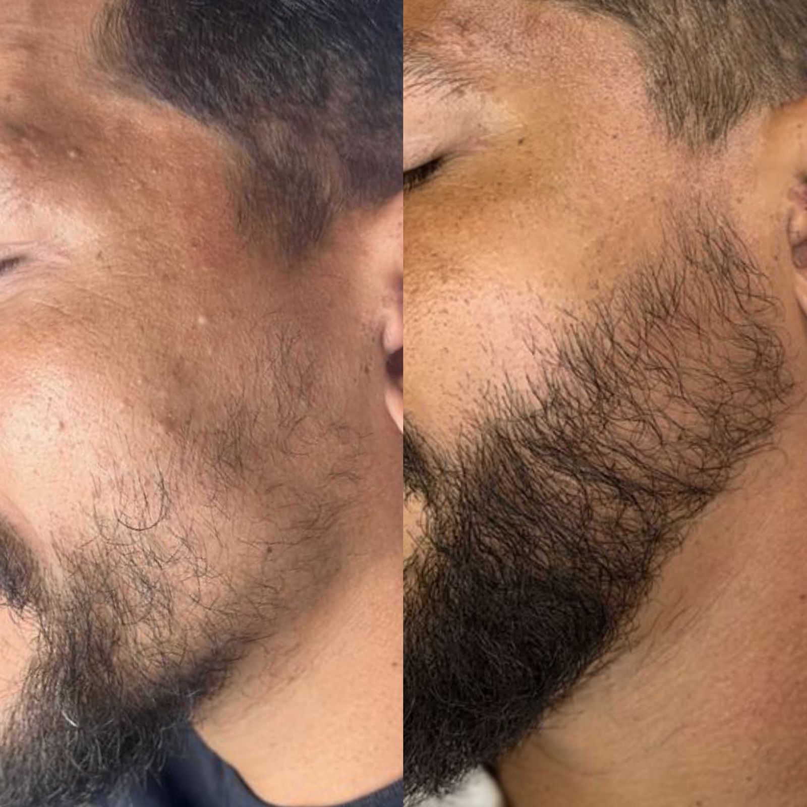 Antes e depois de reconstrução de barba masculina