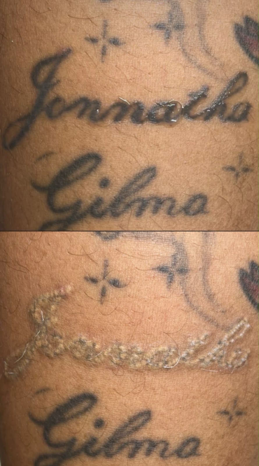Antes e depois de remoção a laser de tatuagem no braço
